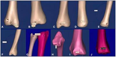 Measurement of bony anatomical parameters of the distal ulna based on healthy adult data: A cross-sectional study